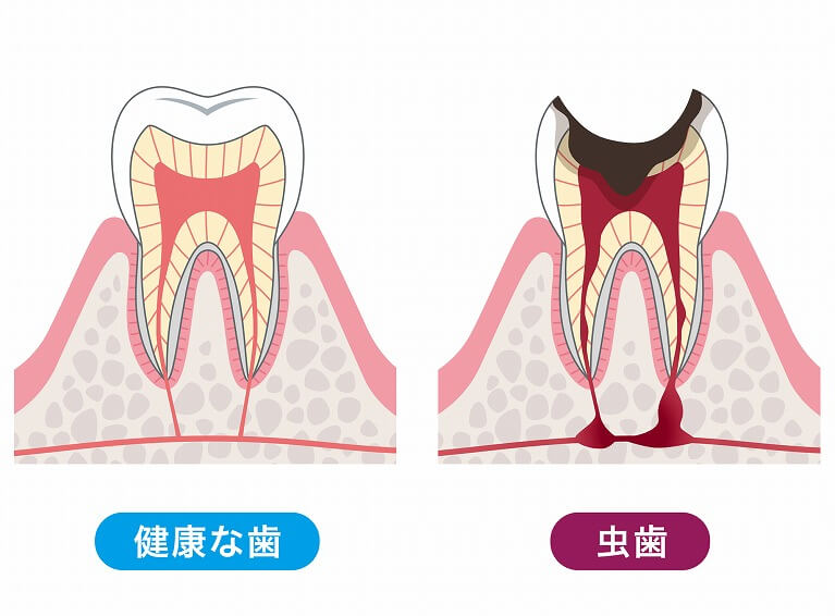 むし歯について