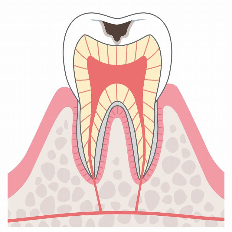 C2：象牙質のむし歯