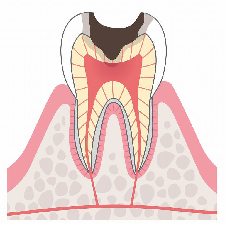 C3：神経のむし歯