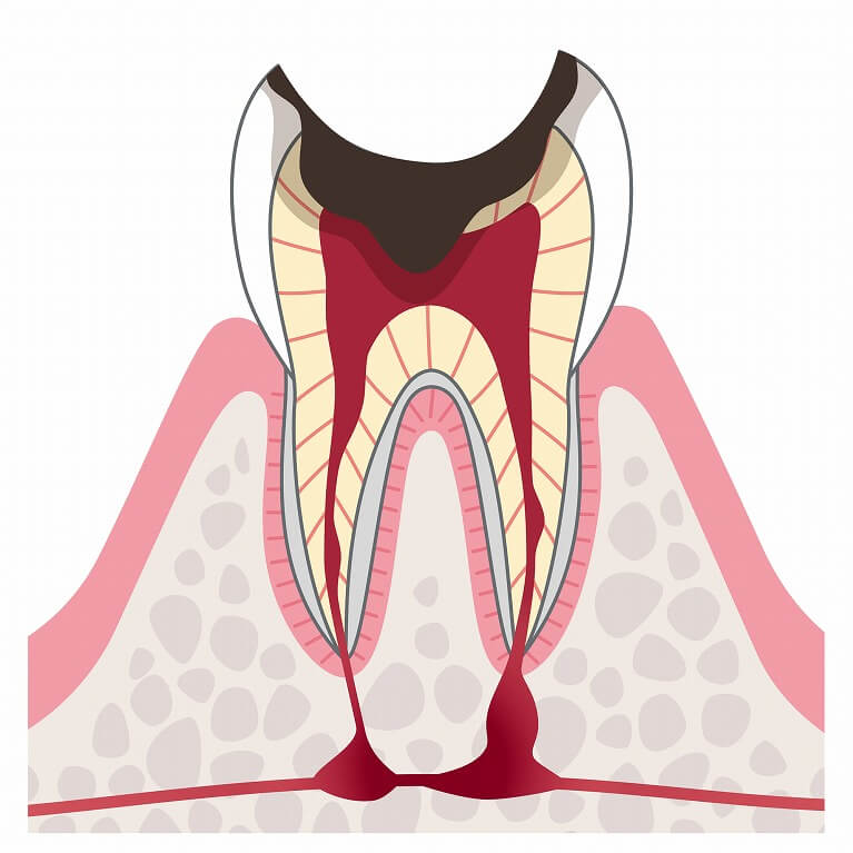 C4：歯根のむし歯