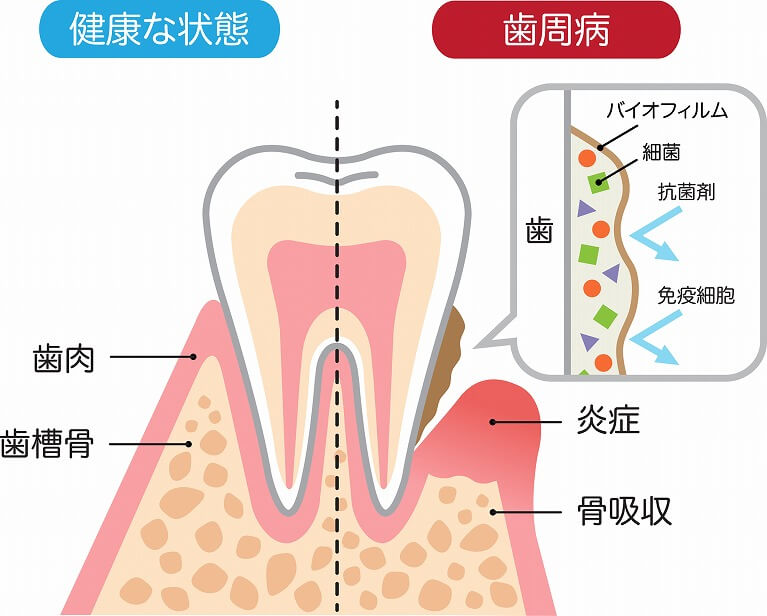 歯周病とは？