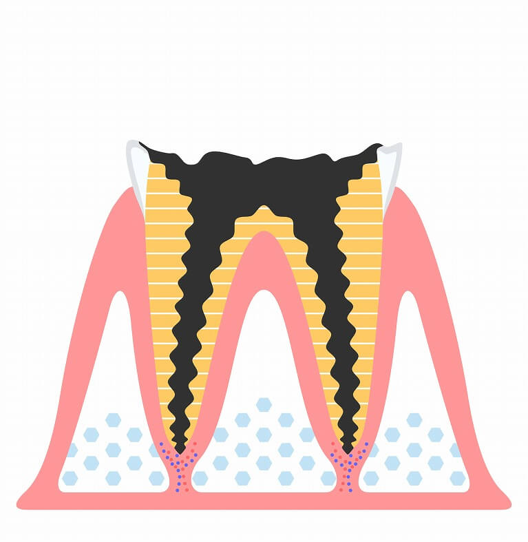 重度のむし歯～根管治療～